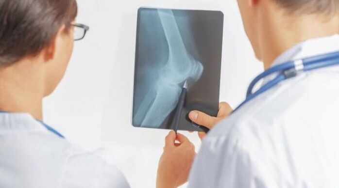 Nach der notwendigen Diagnose einer Arthrose des Kniegelenks verschreiben Ärzte eine komplexe Behandlung. 