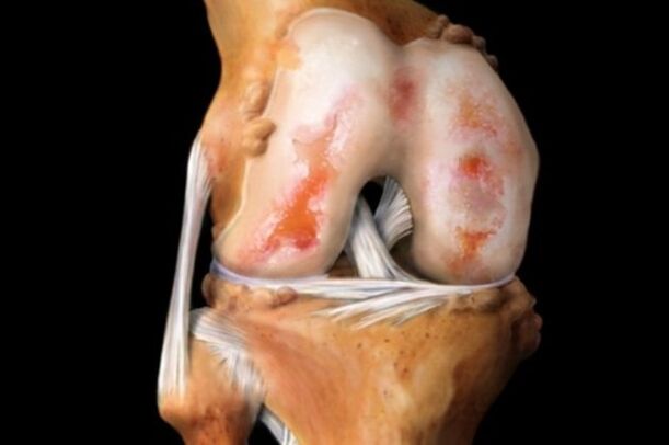 Zerstörung des Kniegelenks durch Arthrose, eine häufige Erkrankung des Bewegungsapparates
