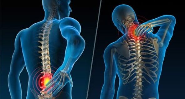 Anzeichen für die Entwicklung von Osteochondrose-Schmerzen im Nacken und im unteren Rückenbereich. 