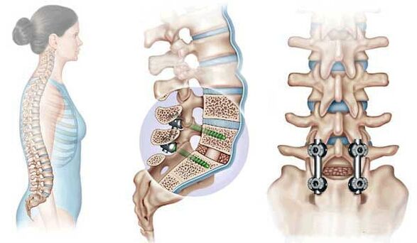 Fixierung verlagerter Wirbel mit Implantaten im fortgeschrittenen Stadium der Osteochondrose. 
