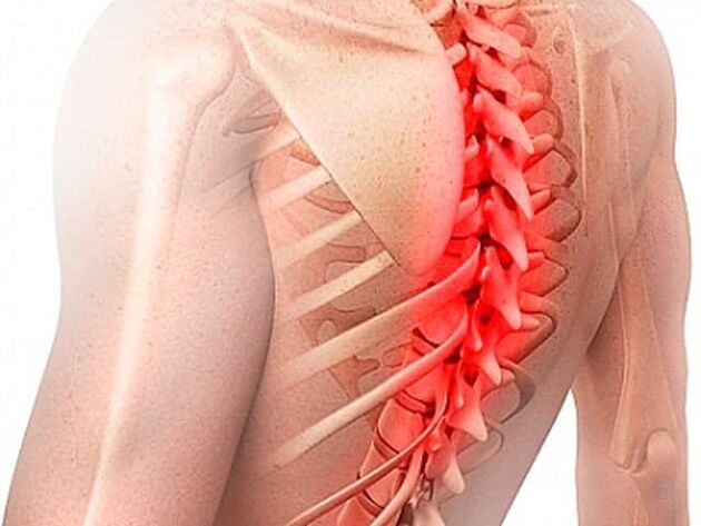Osteochondrose der Brustwirbelsäule ist eine seltene Form der Erkrankung. 