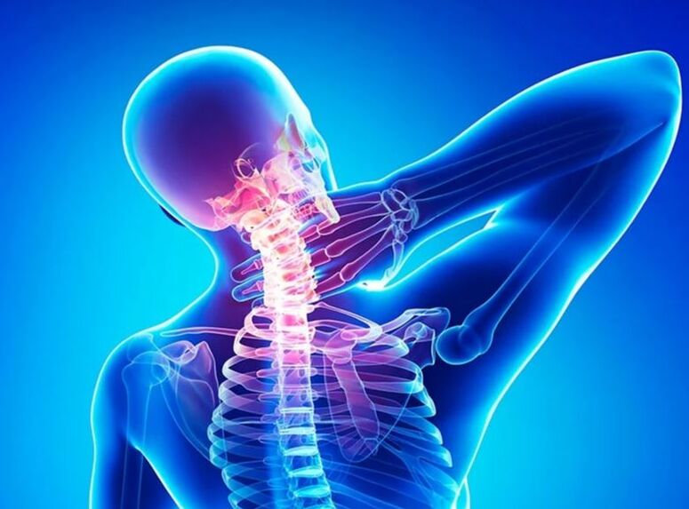 Osteochondrose der Halsspalte