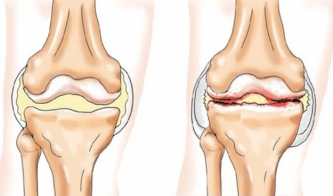 Unterschiede bei Arthritis und Arthrose