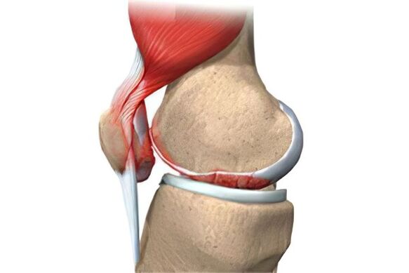 Arthrosekomplikationen