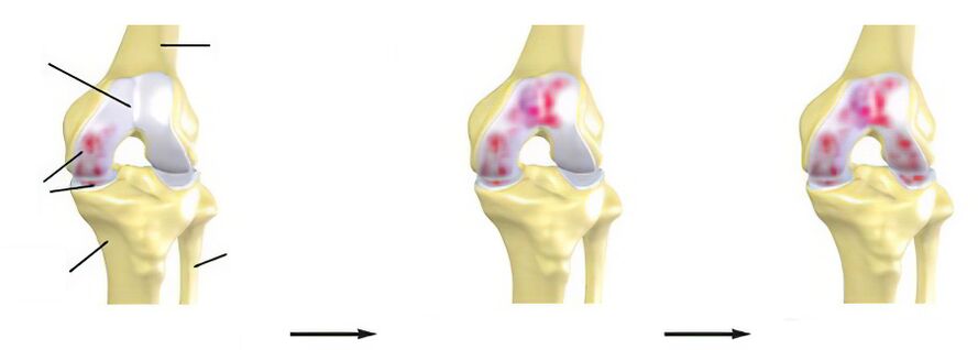 Stadien der Arthrose