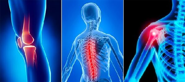 Gelenkschmerzen bei Arthritis