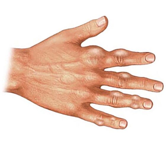 Ablagerung von Harnsäurekristallen in den Weichteilen der Finger bei Gichtarthritis.