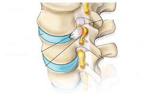 Hauptsymptome der zervikalen Osteochondrose