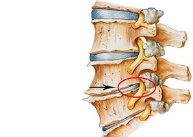 Ursachen der zervikalen Osteochondrose