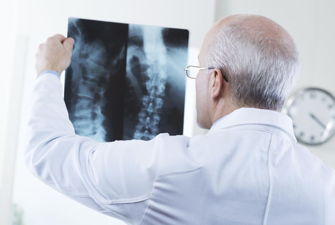 der Arzt untersucht eine Momentaufnahme der Halswirbelsäule mit Osteochondrose